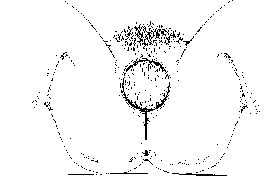 Figure 4 Median Incision