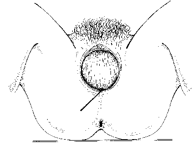 Figure 3. Right Mediolateral Incision